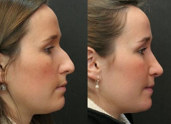 Before and after rhinoplasty is not a surgical