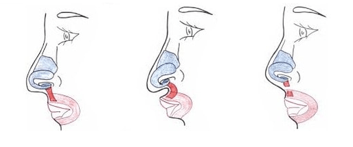 Cutting part of the nasal muscles