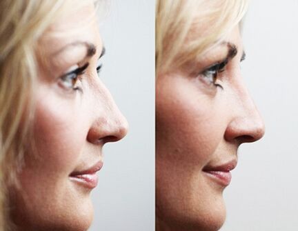 Before and after rhinoplasty with fillers