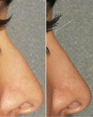 Before and after rhinoplasty without surgery
