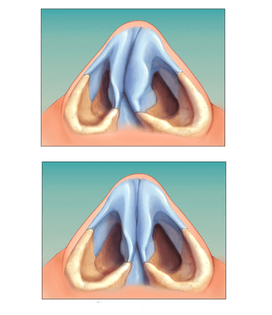 nasal septum corrected
