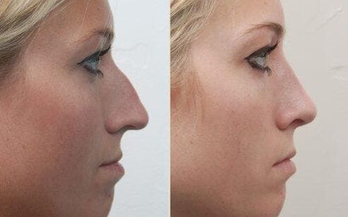 Before and after rhinoplasty without surgery