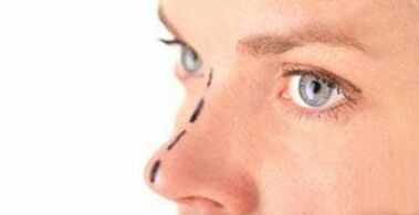 Marking on the nose to insert cosmetic thread