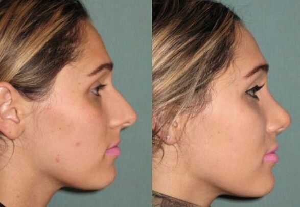 results of rhinoplasty without injections