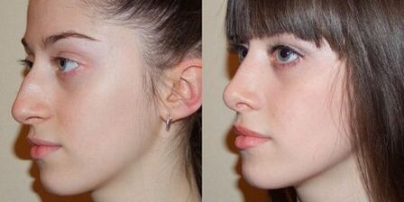 pictures before and after nasal rhinoplasty