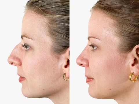 pictures before and after rhinoplasty