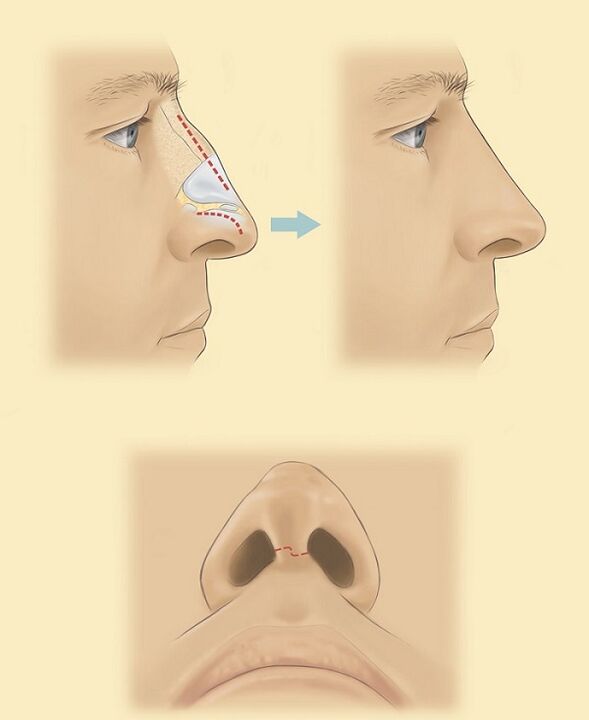 scheme for nasal rhinoplasty