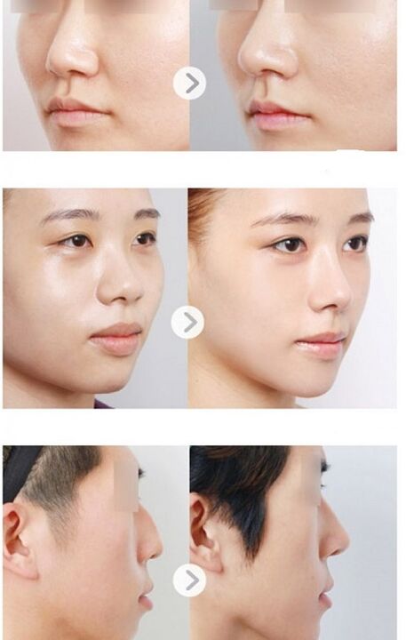 before and after non -surgical rhinoplasty