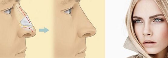 correction of nasal shape with non -surgical rhinoplasty