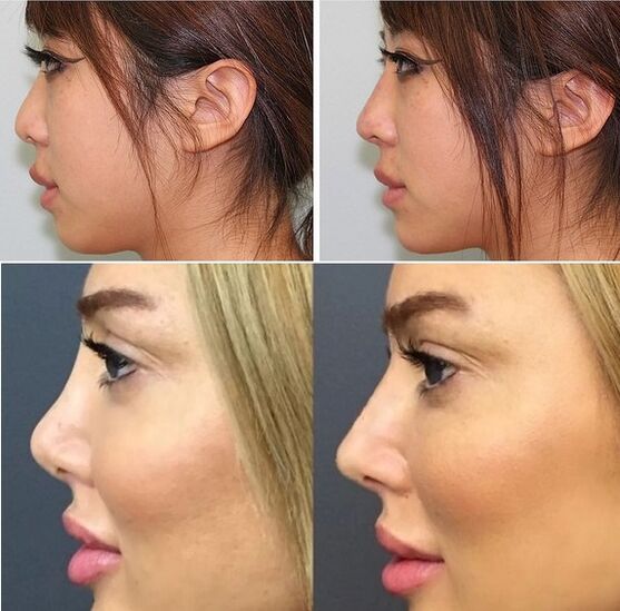 pictures before and after non -surgical rhinoplasty