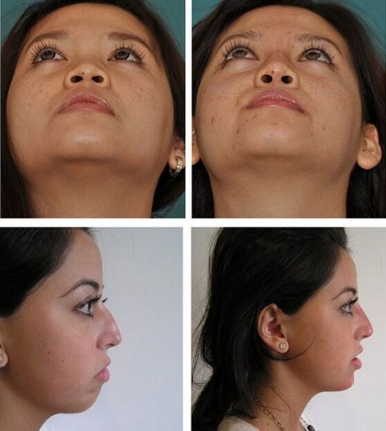 pictures before and after rhinoplasty without surgery