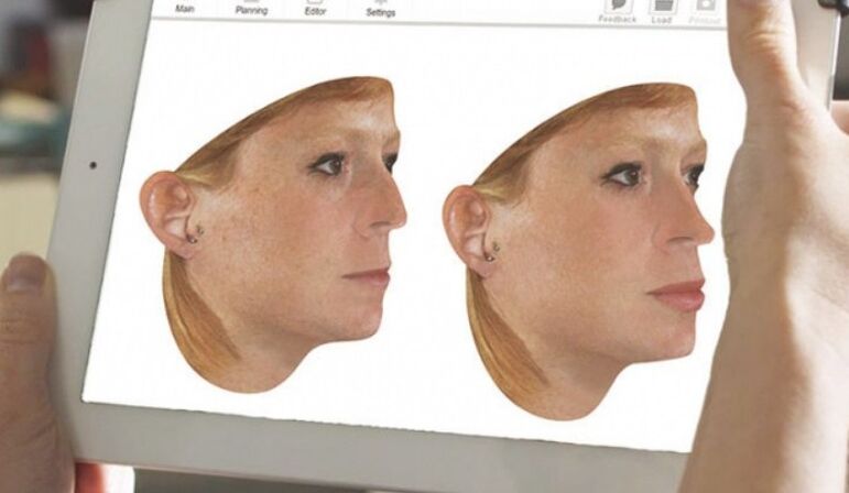 Computer modeling methods of the nose before rhinoplasty