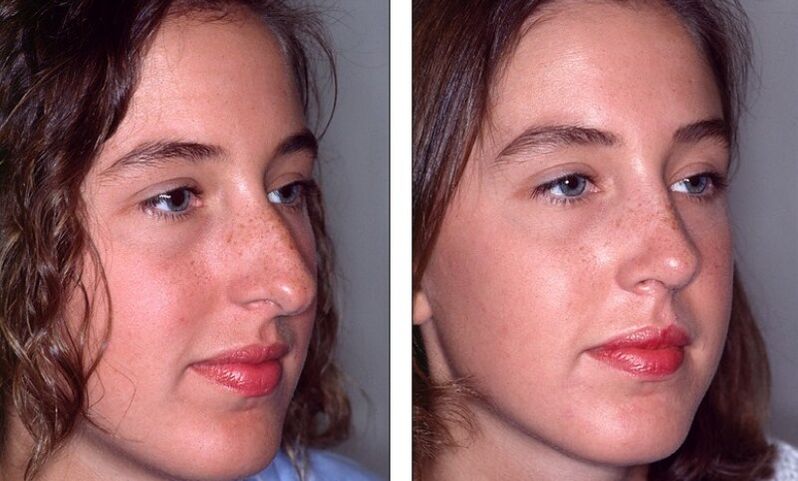 Nose before and after rhinoplasty failed