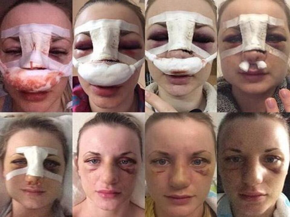 pictures immediately after rhinoplasty