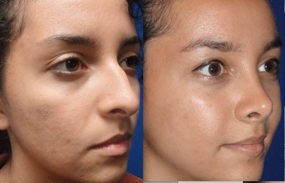 before and after closed rhinoplasty pictures