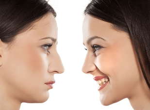 Rhinoplasty nose-before-and-after -