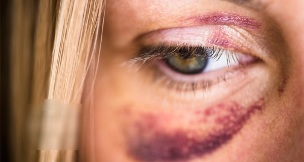 The bruises on her face
