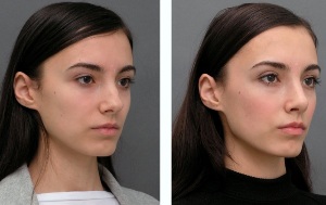 The girl in the before-and-after-rhinoplasty-nose